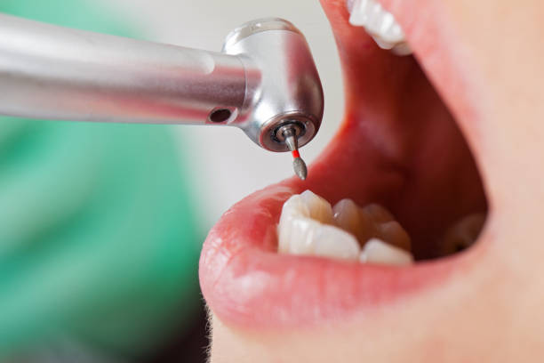 Best Root Canal Emergency Dentist  in Howland Center, OH